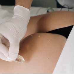 Dermassy AMPOLLAS CONCENTRË Cafeína 20% x 5 ampollas